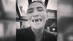 缺牙明星,从微笑困境到自信绽放